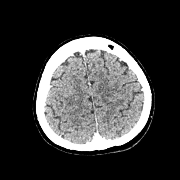 Cerebral ring enhancing lesions - cerebral metastases (Radiopaedia 44922-48818 B 231).jpg