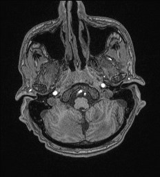 File:Cerebral toxoplasmosis (Radiopaedia 43956-47461 Axial T1 10).jpg
