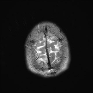 File:Cerebral toxoplasmosis (Radiopaedia 43956-47461 Axial T2 21).jpg