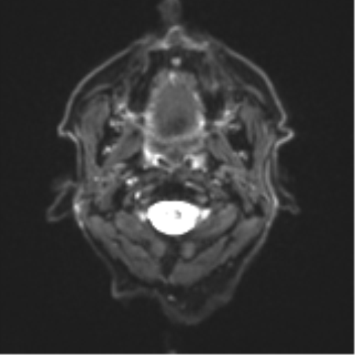 File:Cerebral toxoplasmosis (Radiopaedia 54575-60804 Axial DWI 2).png