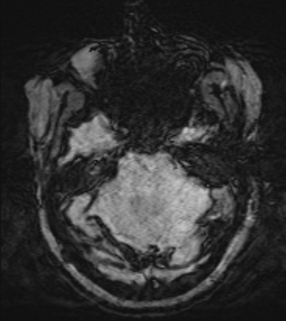 Cerebral venous infarct (Radiopaedia 53627-59685 Axial SWI 13).jpg