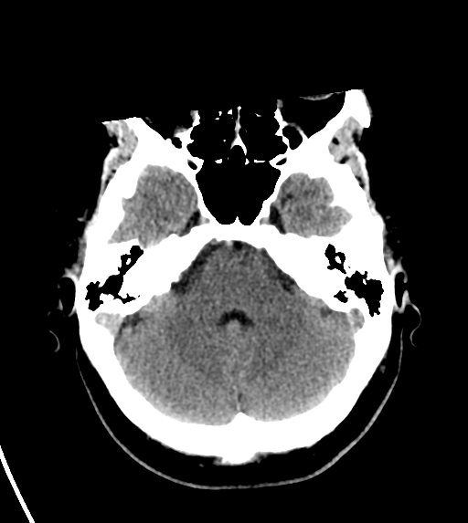 File:Cerebral venous infarct related to dural venous sinus thromboses (Radiopaedia 35292-36804 Axial non-contrast 8).png