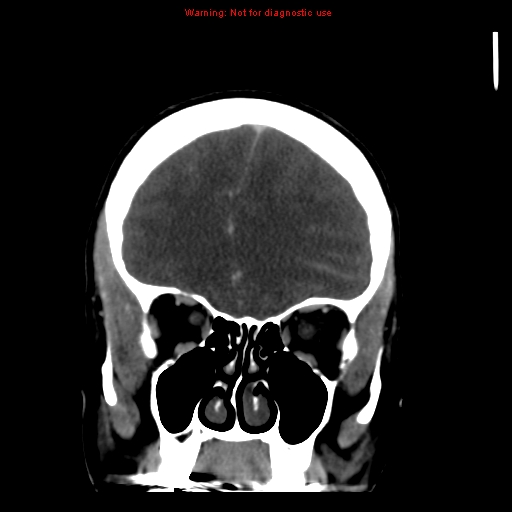 Cerebral venous infarction (Radiopaedia 12404-20735 B 20).jpg