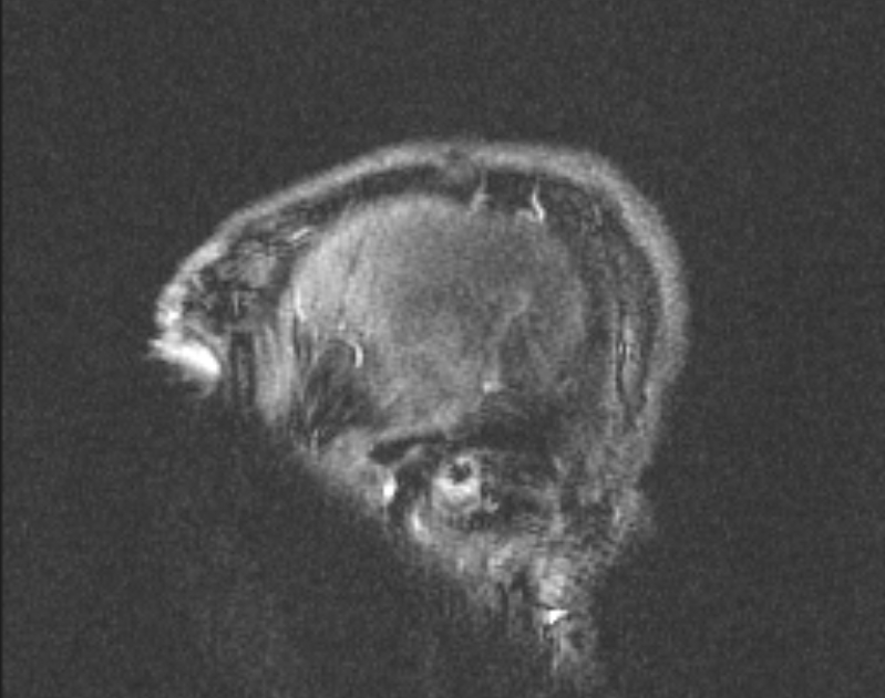 Cerebral venous infarction (Radiopaedia 65166-74176 Sagittal TOF 69).jpg