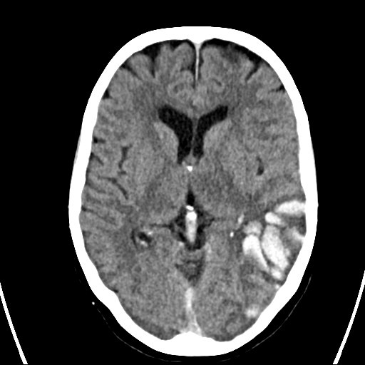 File:Cerebral venous infarction with hemorrhage (Radiopaedia 65343-74381 Axial non-contrast 12).jpg