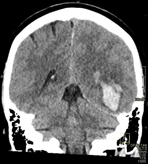 Cerebral venous sinus thrombosis (Radiopaedia 91329-108965 Coronal non-contrast 38).jpg