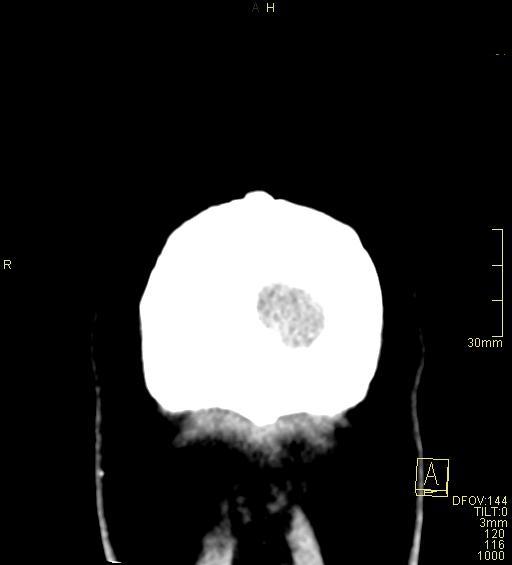 File:Cerebral venous sinus thrombosis (Radiopaedia 91329-108965 Coronal non-contrast 56).jpg