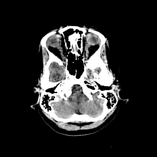 Cerebral venous throbmosis - hemorrhagic venous infarction (Radiopaedia 87318-103613 Axial non-contrast 30).jpg