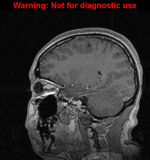 Cerebral venous thrombosis (Radiopaedia 37224-39208 Sagittal T1 C+ 98).jpg