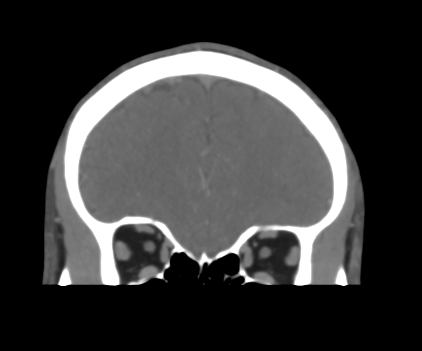 File:Cerebral venous thrombosis (Radiopaedia 38392-40467 Coronal CTA-Venogram 16).png