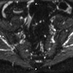 File:Cervical adenocarcinoma (Radiopaedia 65011-73985 Axial DWI 76).jpg