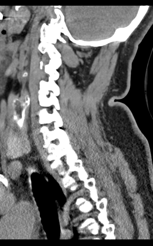 Cervical canal stenosis due to ossification of the posterior longitudinal ligament (Radiopaedia 47260-51823 D 52).png