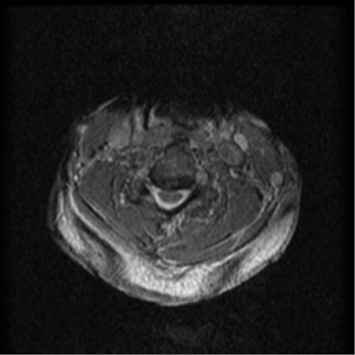 Cervical canal stenosis with cord compression (Radiopaedia 34114-35374 Axial Gradient Echo 44).png