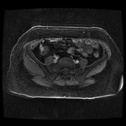 File:Cervical carcinoma (Radiopaedia 70924-81132 Axial T1 C+ fat sat 165).jpg