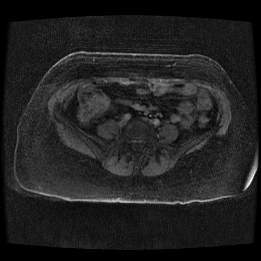 File:Cervical carcinoma (Radiopaedia 70924-81132 Axial T1 C+ fat sat 173).jpg