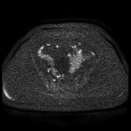 File:Cervical carcinoma (Radiopaedia 85405-101028 Axial DWI 75).jpg