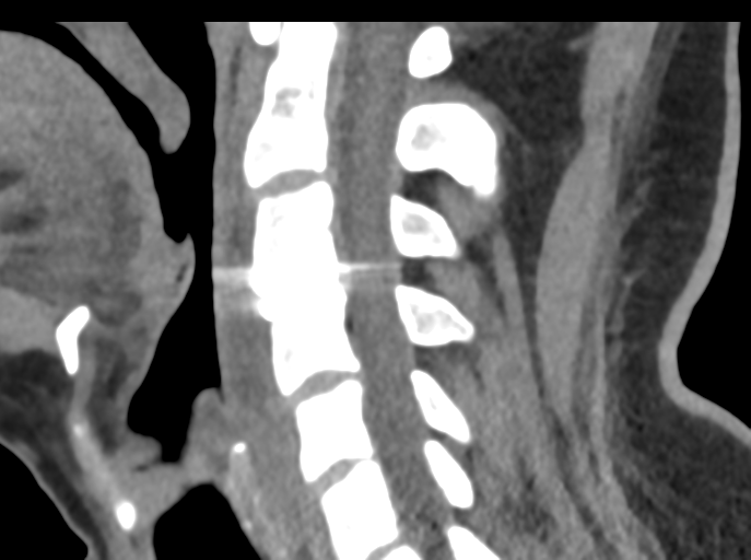 Cervical disc replacement (Radiopaedia 44025-47541 B 53).png