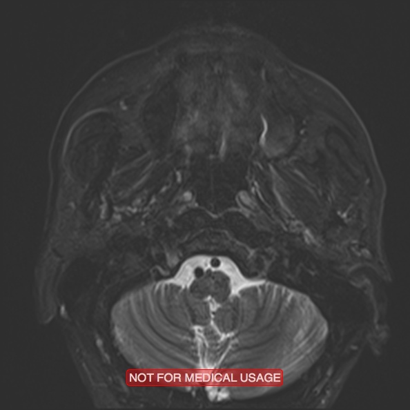 File:Cervical nerve schwannoma (Radiopaedia 27964-28221 C 17).jpg