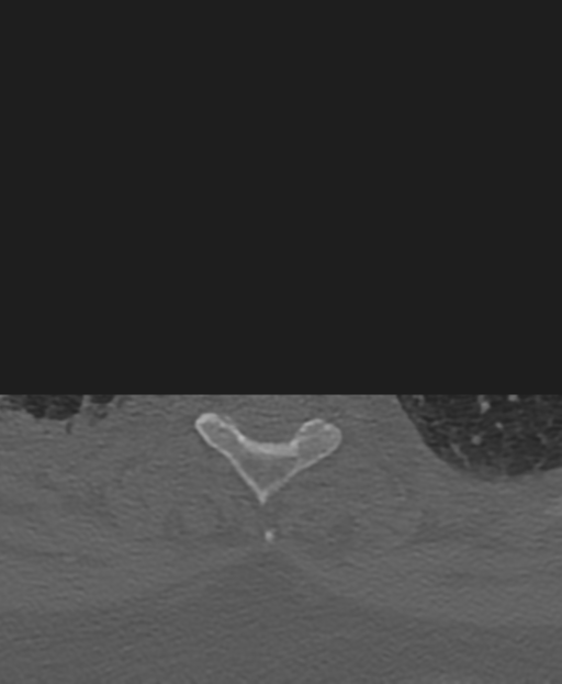 Cervical spine ACDF loosening (Radiopaedia 48998-54071 Axial bone window 64).png