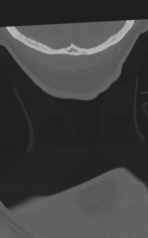 Cervical spine fractures with vertebral artery dissection (Radiopaedia 53296-59268 Coronal bone window 86).png