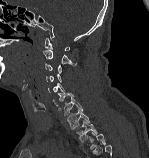 File:Cervical spine trauma with tear drop fracture and perched facet joint (Radiopaedia 53989-60127 Sagittal bone window 111).jpg