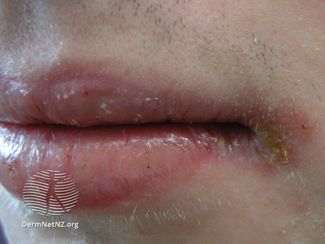 File:Cheilitis (DermNet NZ treatments-isotretinoin-cheilitis).jpg