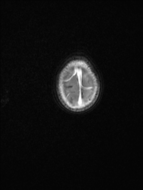 Chiari III malformation with occipital encephalocele (Radiopaedia 79446-92559 Axial T1 C+ mpr 77).jpg