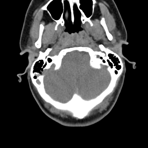Chiari I malformation and obstructive hydrocephalus (Radiopaedia 41185-43981 D 29).png