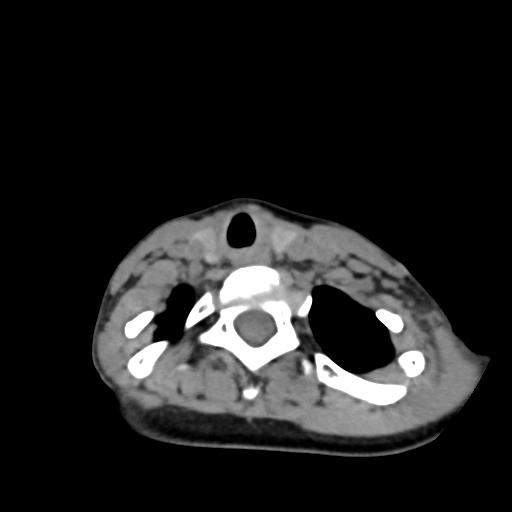 Chiari I with syrinx and skull base anomalies (Radiopaedia 89444-106412 Axial non-contrast 118).jpg