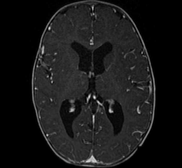 Chiasmatic-hypothalamic glioma (Radiopaedia 90079-107252 Axial T1 C+ 47).jpg