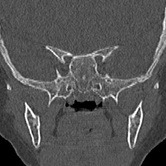 File:Choanal atresia (Radiopaedia 88525-105975 Coronal bone window 89).jpg