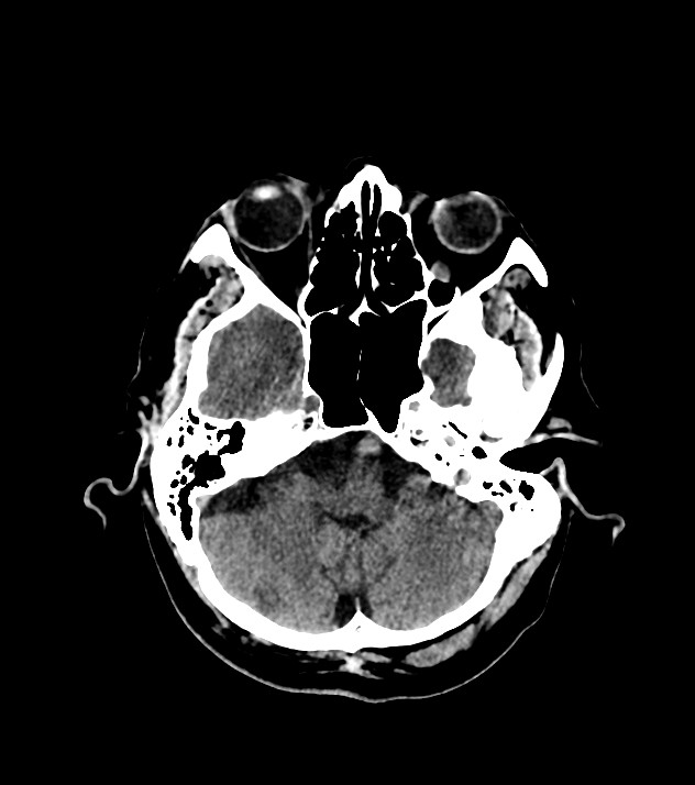 Cholangiocarcinoma with cerebral metastases (Radiopaedia 83519-98628 Axial non-contrast 19).jpg