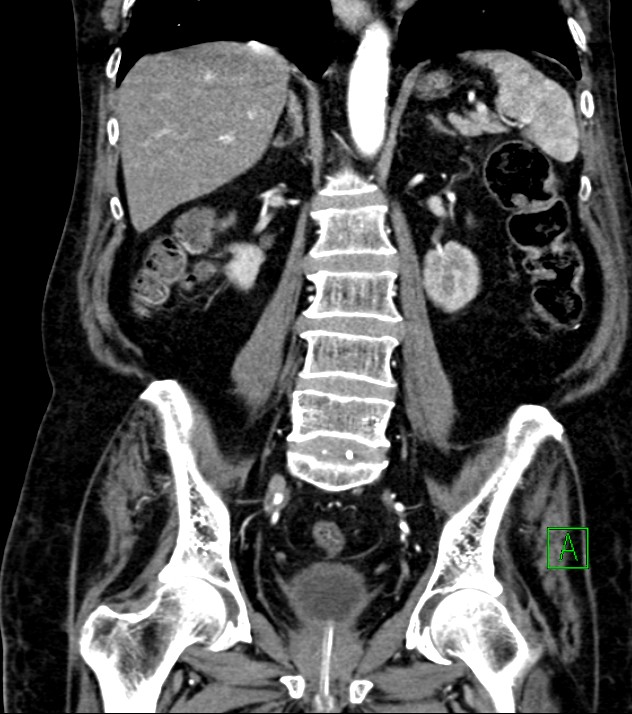 Cholangiocarcinoma with cerebral metastases (Radiopaedia 83519-98629 E 55).jpg