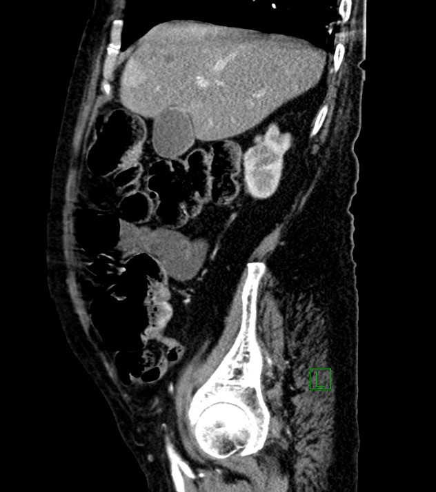 Cholangiocarcinoma with cerebral metastases (Radiopaedia 83519-98629 F 89).jpg