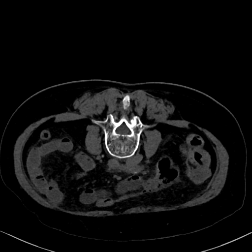File:Cholecystitis - obstructive choledocholitiasis (CT intravenous cholangiography) (Radiopaedia 43966-47479 Axial 76).png