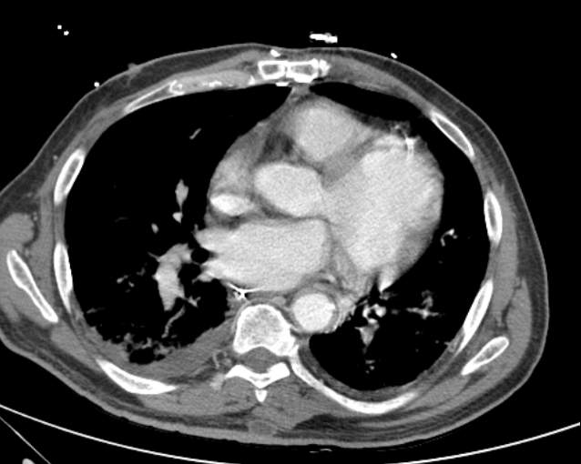 Cholecystitis - perforated gallbladder (Radiopaedia 57038-63916 A 3).jpg