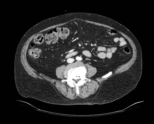 File:Cholecystoduodenal fistula (Radiopaedia 48959-54022 A 8).jpg