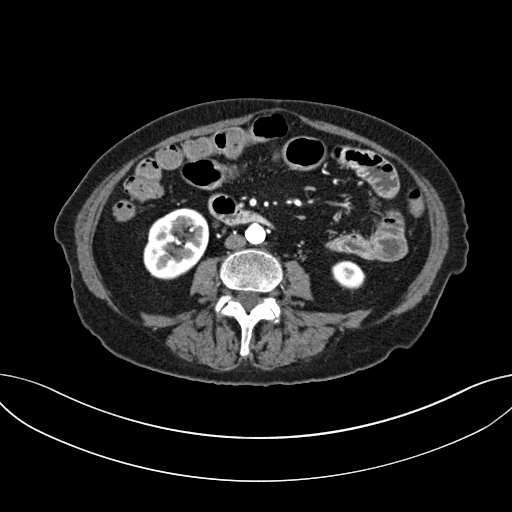 Cholecystoduodenal fistula due to calculous cholecystitis with gallstone migration (Radiopaedia 86875-103077 A 39).jpg