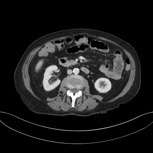 Cholecystoduodenal fistula due to calculous cholecystitis with gallstone migration (Radiopaedia 86875-103077 D 40).jpg