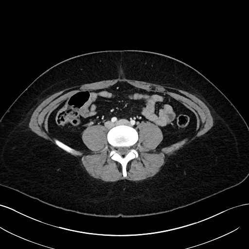File:Choledocholithiasis after recent cholecystectomy (Radiopaedia 60929-68737 Axial 10).jpg