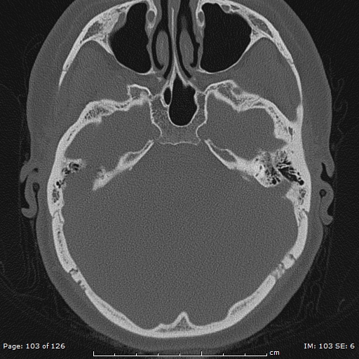 Cholesteatoma - external auditory canal (Radiopaedia 88452-105096 Axial bone window 66).jpg