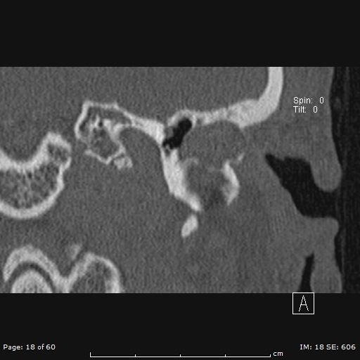 Cholesteatoma - external auditory canal (Radiopaedia 88452-105096 Coronal bone window 18).jpg