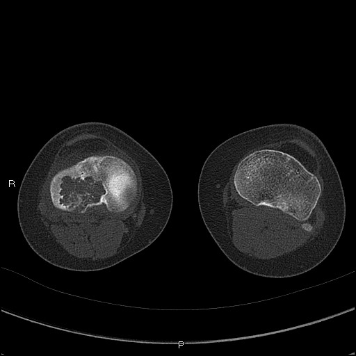 Chondroblastoma (Radiopaedia 62721-71030 Axial bone window 48).jpg