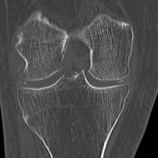 Chondrocalcinosis (Radiopaedia 16275-15955 Coronal bone window 34).jpg