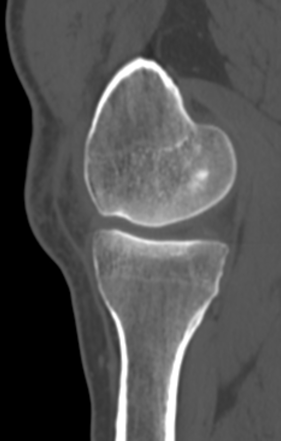 Chondrocalcinosis (Radiopaedia 82862-97173 Sagittal bone window 20).jpg