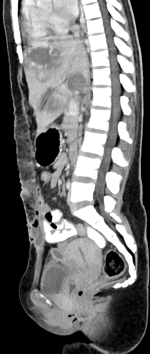 Choriocarcinoma liver metastases (Radiopaedia 74768-85766 C 98).jpg