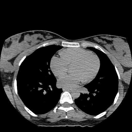 File:Choriocarcinoma of ovary with cerebral and pulmonary metastases (Radiopaedia 25983-26119 Axial non-contrast 150).jpg