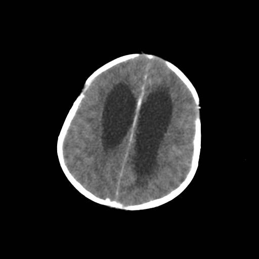 Choroid plexus papilloma (Radiopaedia 63946-72698 Axial with contrast 56).jpg
