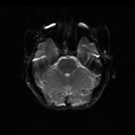 File:Choroid plexus xanthogranuloma (Radiopaedia 17650-17386 ADC 17).jpg