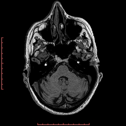 Choroid plexus xanthogranuloma (Radiopaedia 67843-77270 Axial T1 125).jpg